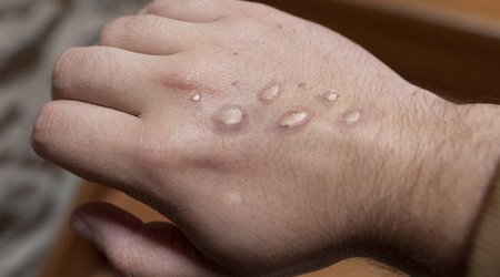 Belgium records first monkeypox death