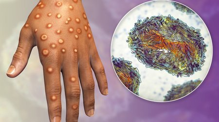 No monkeypox cases recorded in Azerbaijan