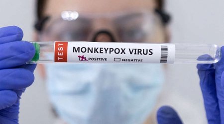 First monkeypox death confirmed in US