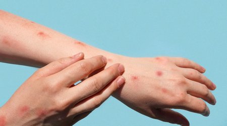 Number of measles infections rises to 50 in Armenia