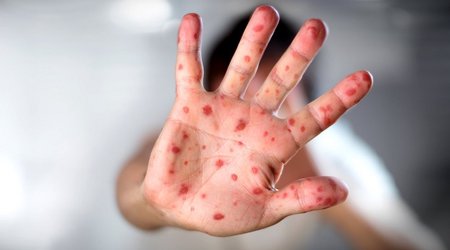 Number of measles patients in Armenia grows to 201
