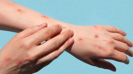В ВОЗ сообщили о выявлении почти 92 тыс. случаев оспы обезьян в мире с января 2022 года