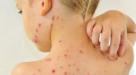 Вакцинация - единственный и самый эффективный способ защиты от кори
