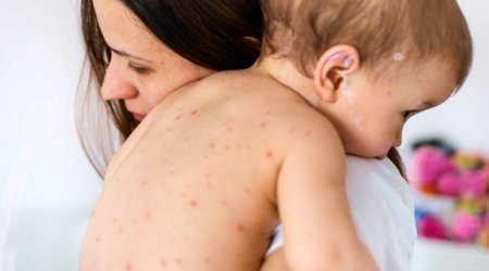 Number of confirmed measles cases in Armenia reaches 513