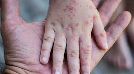 Rumıniyada qızılca epidemiyası təsdiqlənib