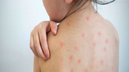 В Баку в приюте корью заразились 40 детей
