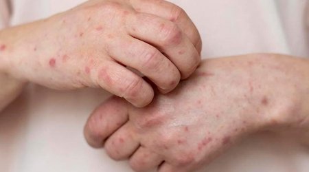 В Джалилабаде студентка скончалась от кори