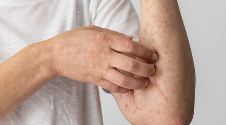 Armenia reports sharp increase in number of measles cases