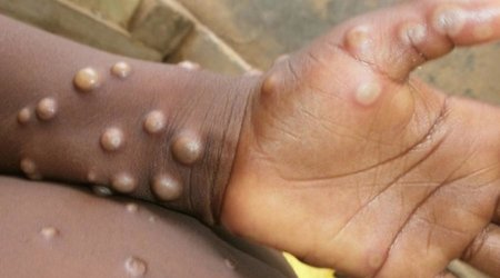 Monkeypox epidemic declared in Congo