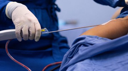 В Сумгайыте 34-летняя женщина скончалась после липосакции