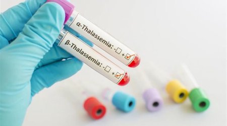 Bəzi talassemiya hallarında yeganə tam müalicə üsulu sümük iliyi transplantasiyasıdır