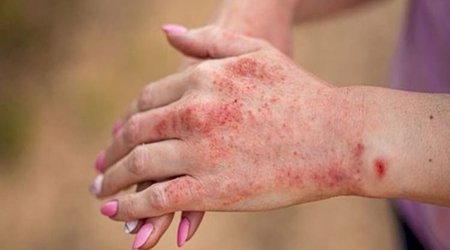 В Бангладеш от лихорадки денге за сутки умерли 12 человек