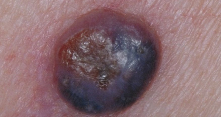 Doctors warn of aggressive form of skin cancer - PHOTO Doctors warn of aggressive form of skin cancer - PHOTO