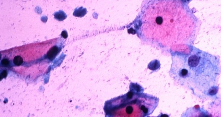 Prostate cancer 'may be a sexually transmitted disease' Prostate cancer 'may be a sexually transmitted disease'