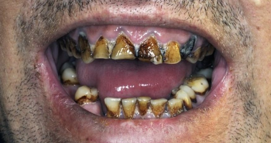 Lasers 'could prevent' need for root canal treatment Lasers 'could prevent' need for root canal treatment