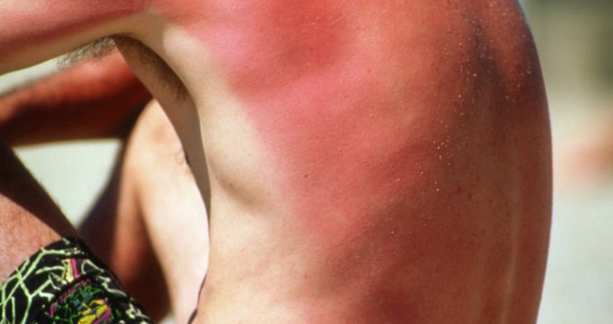 Sunbathing 'may be addictive' warning - PHOTO Sunbathing 'may be addictive' warning - PHOTO