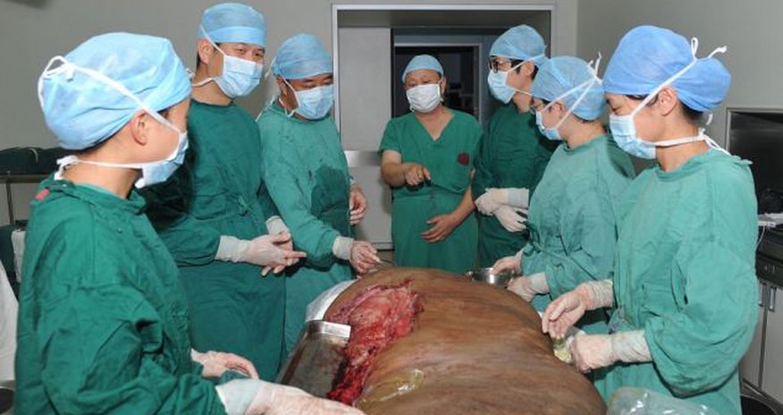 Man has world's 'largest tumour' removed from his leg - PHOTO Man has world's 'largest tumour' removed from his leg - PHOTO
