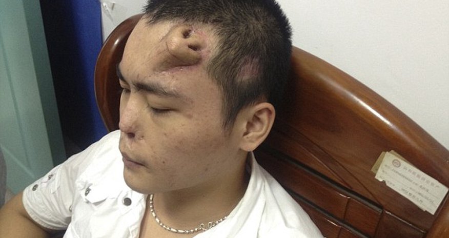 Stem cell patient ACCIDENTALLY grows a NOSE on her back - PHOTO+VIDEO Stem cell patient ACCIDENTALLY grows a NOSE on her back - PHOTO+VIDEO