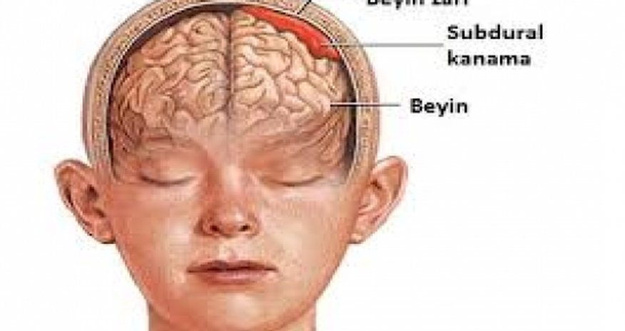 Beyin qanamasının əlamətləri Beyin qanamasının əlamətləri