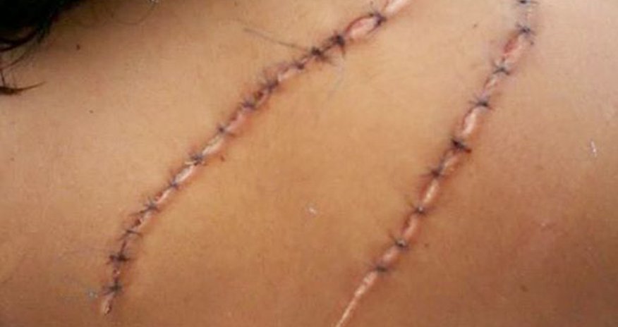 Teenage girl left disfigured after 'jealous rivals mutilate her for being too pretty' - PHOTO Teenage girl left disfigured after 'jealous rivals mutilate her for being too pretty' - PHOTO