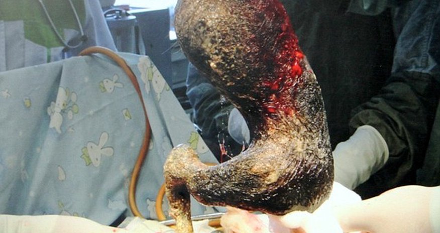 The girl with the 9lb HAIRBALL - PHOTO The girl with the 9lb HAIRBALL - PHOTO