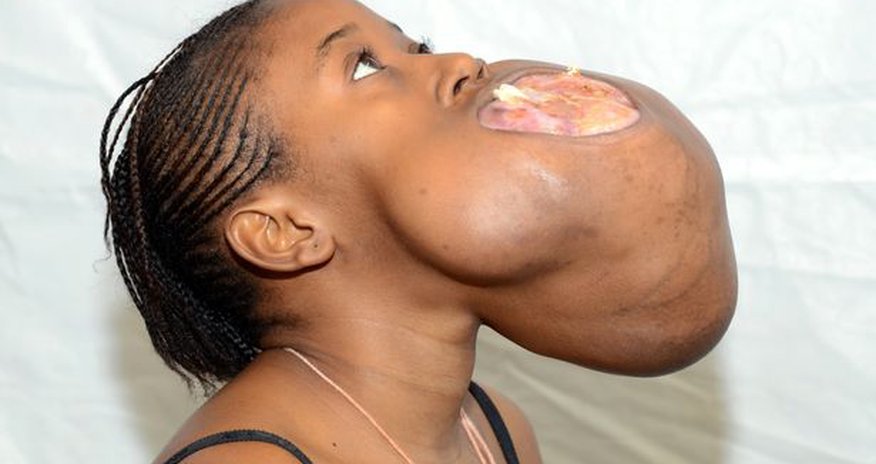 Teenager has giant tumour the size of a FOOTBALL removed - PHOTO Teenager has giant tumour the size of a FOOTBALL removed - PHOTO