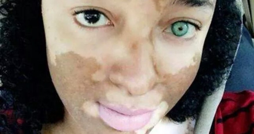 Girl born ‘with a permanent tattoo of a dog kissing a bunny’ - PHOTO Girl born ‘with a permanent tattoo of a dog kissing a bunny’ - PHOTO
