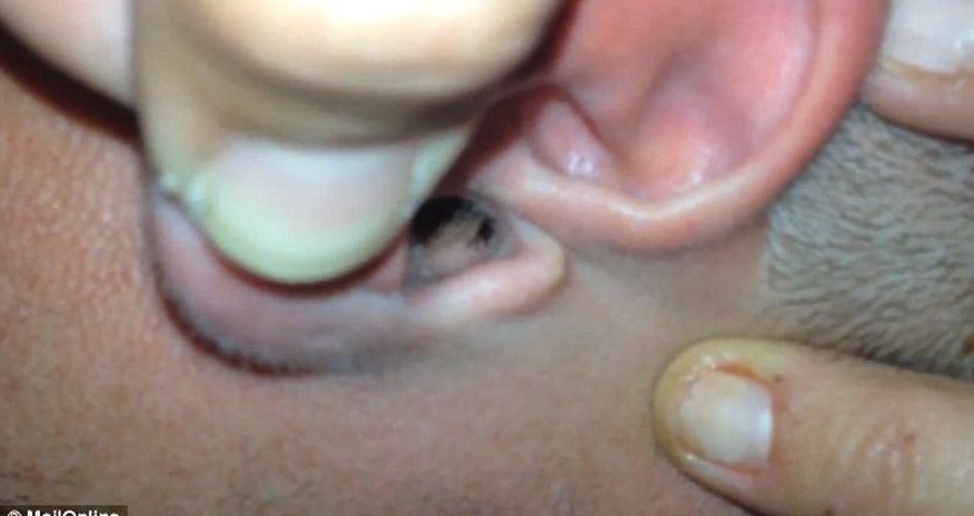 LIVE inch-long moth and a tick are pulled out from a man's ear - PHOTO+VIDEO LIVE inch-long moth and a tick are pulled out from a man's ear - PHOTO+VIDEO