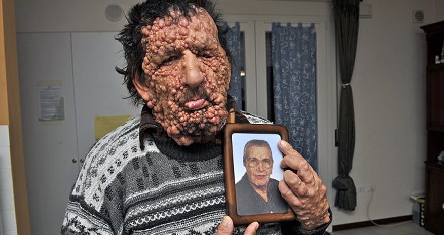Pope Francis blesses severely disfigured man without a face - Pope Francis blesses severely disfigured man without a face -