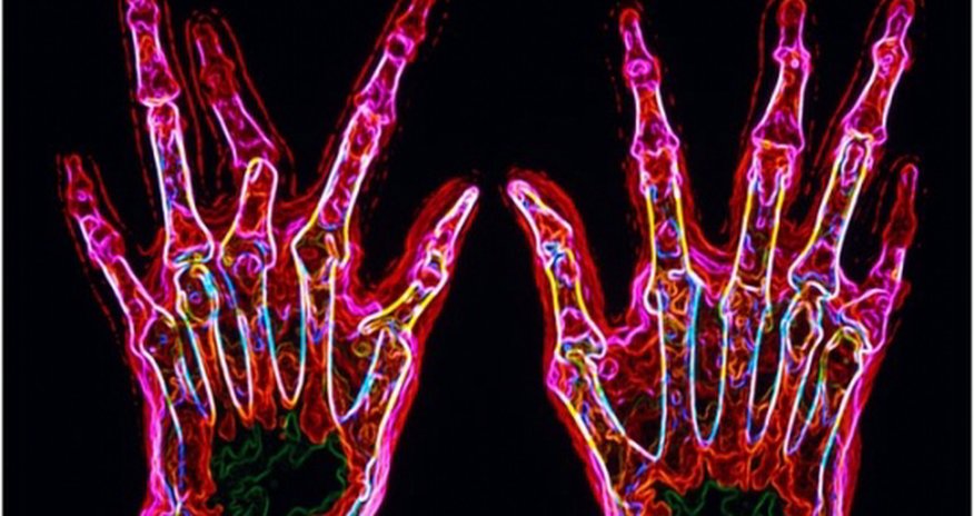 New genetic clues for rheumatoid arthritis 'cure' New genetic clues for rheumatoid arthritis 'cure'