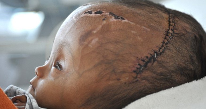 2-year-old has successful surgery to reduce huge swelling - PHOTO 2-year-old has successful surgery to reduce huge swelling - PHOTO