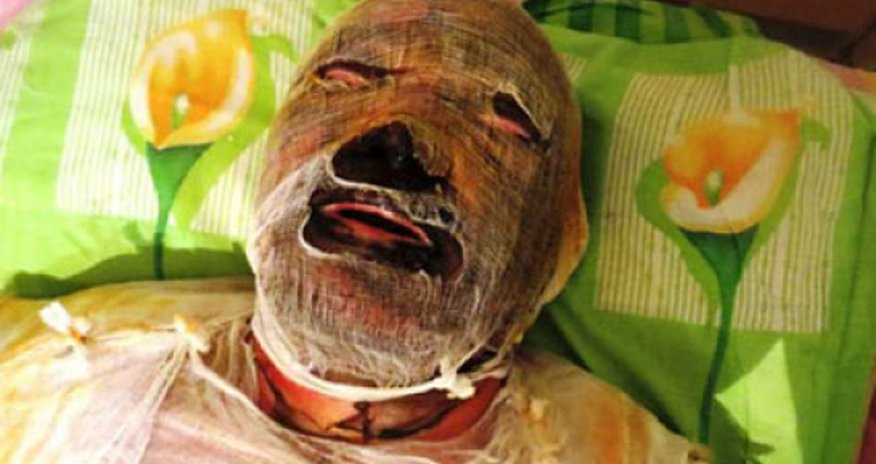 Karabakh war veteran dies of burns in hospital Karabakh war veteran dies of burns in hospital