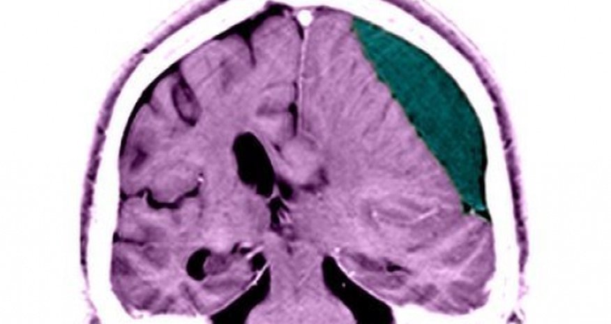 Brain blow leaves life-long dangers Brain blow leaves life-long dangers