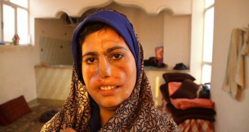 Afghan wife maimed for refusing drug-addict husband's cash demands Afghan wife maimed for refusing drug-addict husband's cash demands