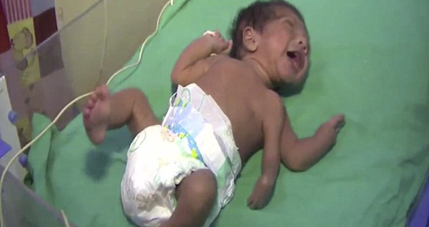 Baby born with THREE arms Baby born with THREE arms