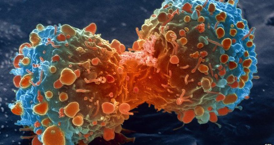 Most cancer types 'just bad luck' Most cancer types 'just bad luck'