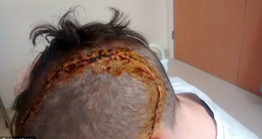 Horrific injuries of 16-year-old boy Horrific injuries of 16-year-old boy