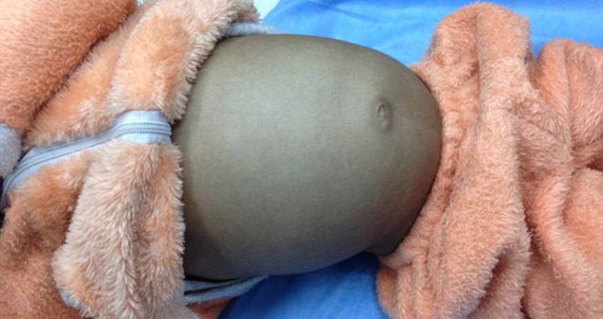 Boy, 4, has huge 4ft hairball removed by doctors Boy, 4, has huge 4ft hairball removed by doctors
