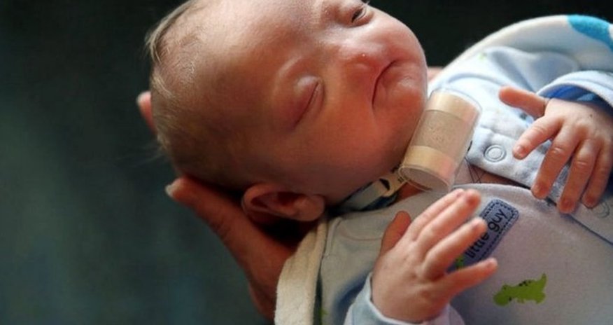 Baby born without a nose, mom says he's perfect Baby born without a nose, mom says he's perfect