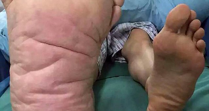 The man whose foot swelled to an astonishing size TWENTY-NINE The man whose foot swelled to an astonishing size TWENTY-NINE