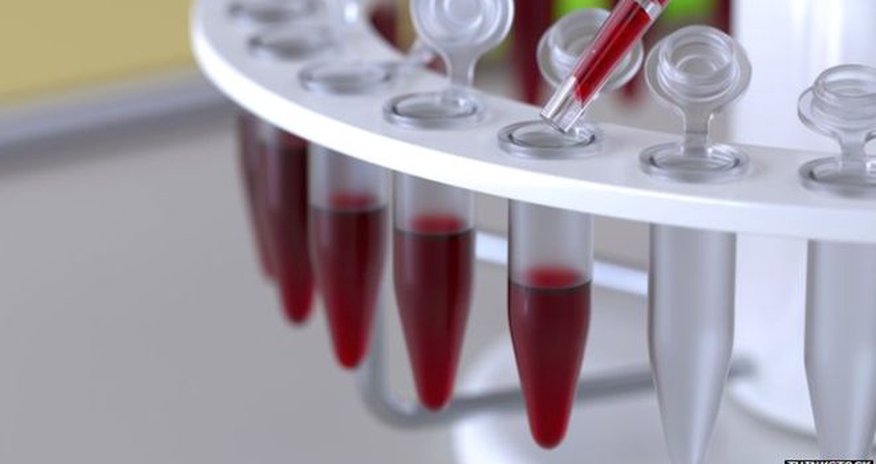Blood test 'boost' in ovarian cancer fight Blood test 'boost' in ovarian cancer fight