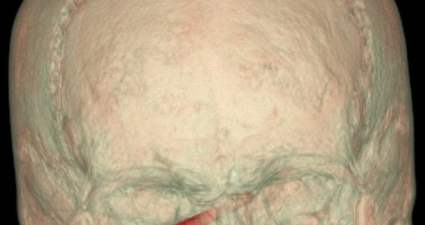 Miracle as gardener with a three inch NAIL stuck in his eye escapes with no sight damage Miracle as gardener with a three inch NAIL stuck in his eye escapes with no sight damage