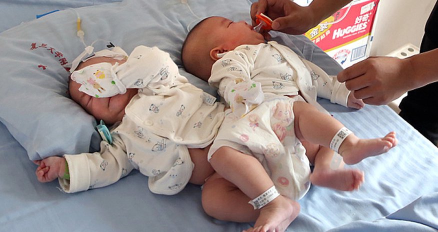 Doctors separate conjoined twins with help of 3D printer Doctors separate conjoined twins with help of 3D printer