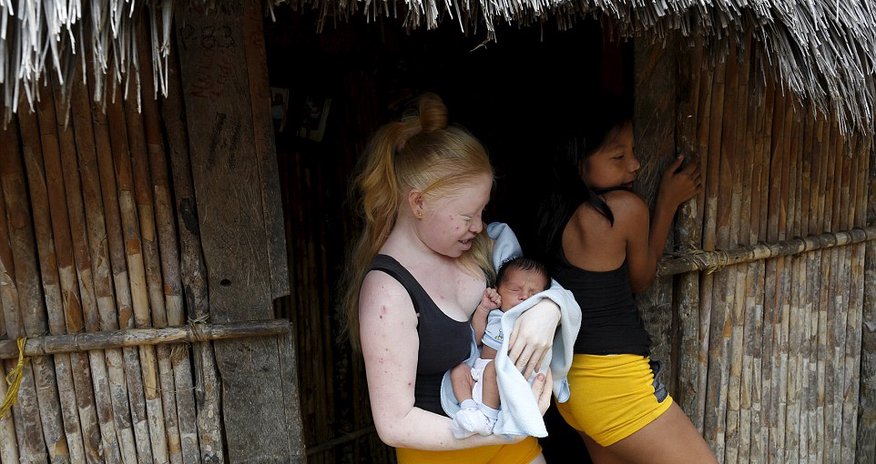 Albino youngsters are forced to stay out of the bright sun in Panama village Albino youngsters are forced to stay out of the bright sun in Panama village