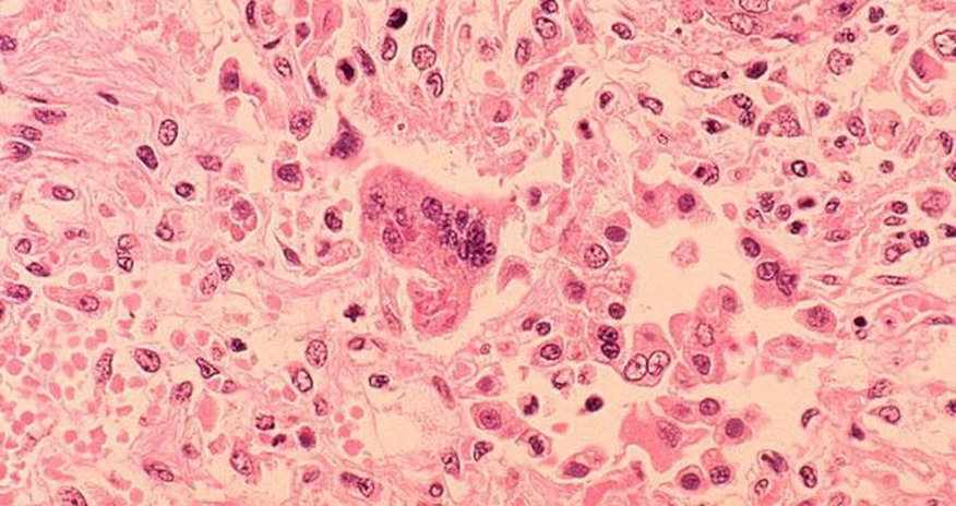 Measles: First death in 12 years reported in Washington state Measles: First death in 12 years reported in Washington state