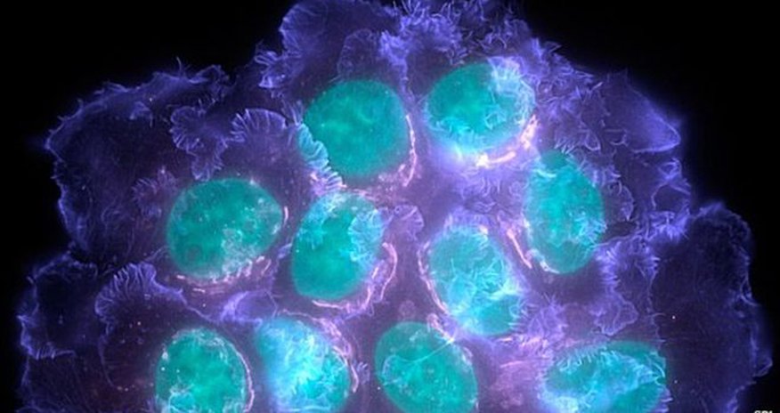 Cheap drugs cut breast cancer deaths by 18% Cheap drugs cut breast cancer deaths by 18%
