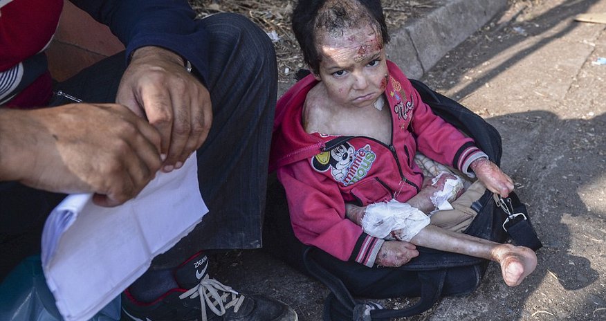 Parents flee Syria with their badly burned little girl Parents flee Syria with their badly burned little girl
