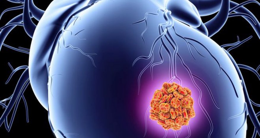Patch may boost repair after heart attack Patch may boost repair after heart attack