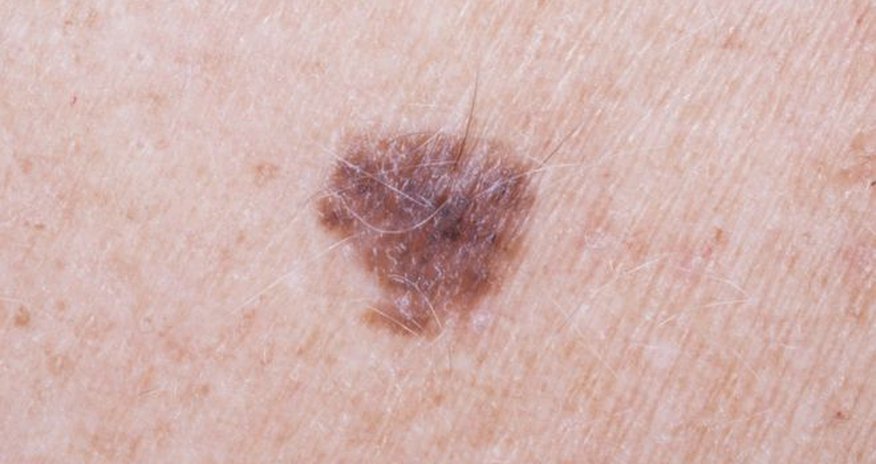 Arm mole count predicts skin cancer risk: study Arm mole count predicts skin cancer risk: study