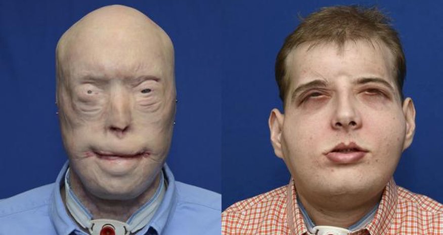 U.S. firefighter gets world's most extensive face transplant U.S. firefighter gets world's most extensive face transplant